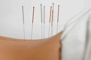 Triggerpunkt-akupunktur
