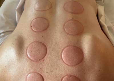 Cupping, Tid til Massage, Aarhus.